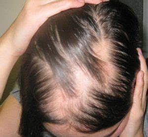 Types of Alopecia