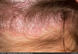 Pink Scalp and Hair Loss